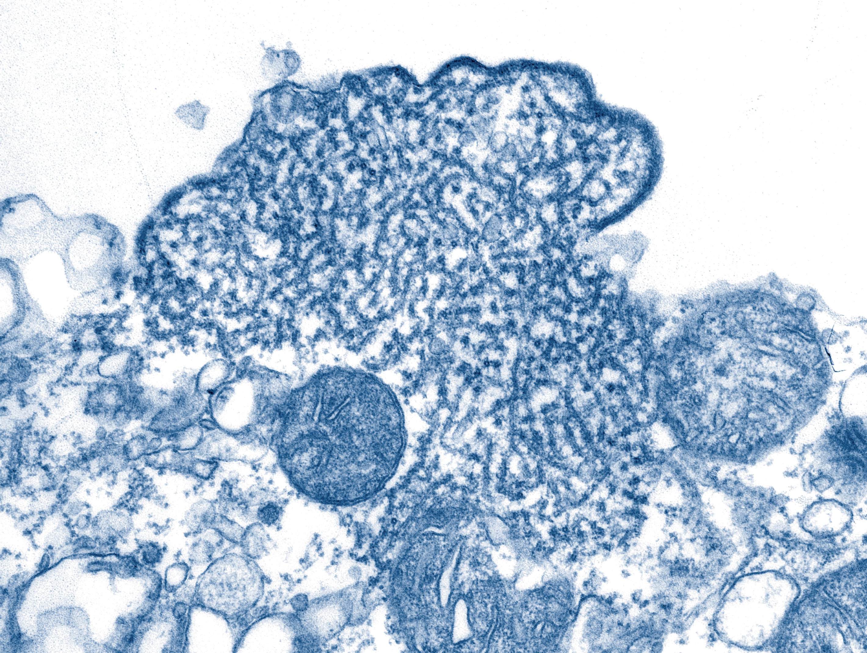 Virus HTLV 1 Femme Et R Alit S   Virus HTLV 1 